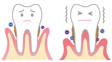 歯周病とは？